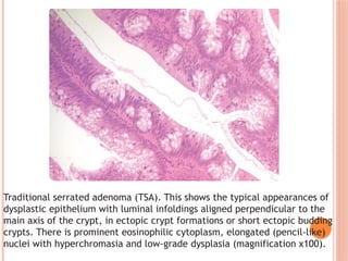serrated lesion of colon and rectum-1.pptx