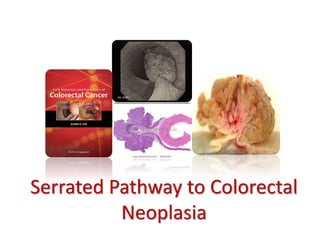 Serrated Pathway to Colorectal
Neoplasia
 
