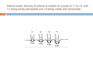 Edema scale. Severity of edema is ranked on a scale of +1 to +4, with
+1 being barely perceptible and +4 being visible and remarkable.
15
 