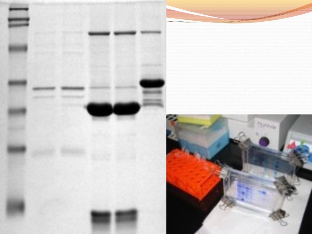 Serum protein electrophoresis & their clinical importance