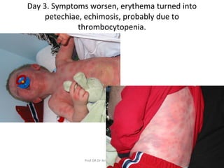 Day 3. Symptoms worsen, erythema turned into
petechiae, echimosis, probably due to
thrombocytopenia.
Prof DR Dr Ariyanto Harsono SpA(K) 12
 