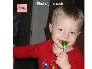 Prof DR Dr Ariyanto Harsono SpA(K) 9
First sign is rash
 