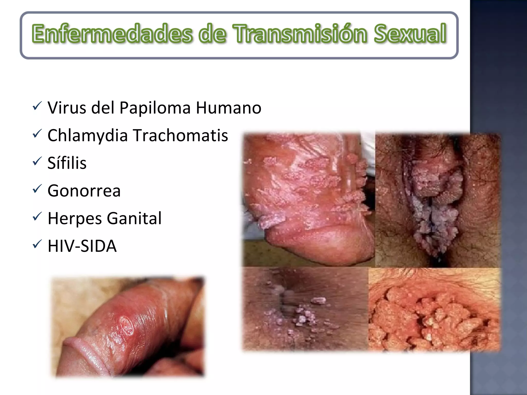 Virus del Papiloma Humano Chlamydia Trachomatis Sífilis Gonorrea Herpes Ganital HIV-SIDA 