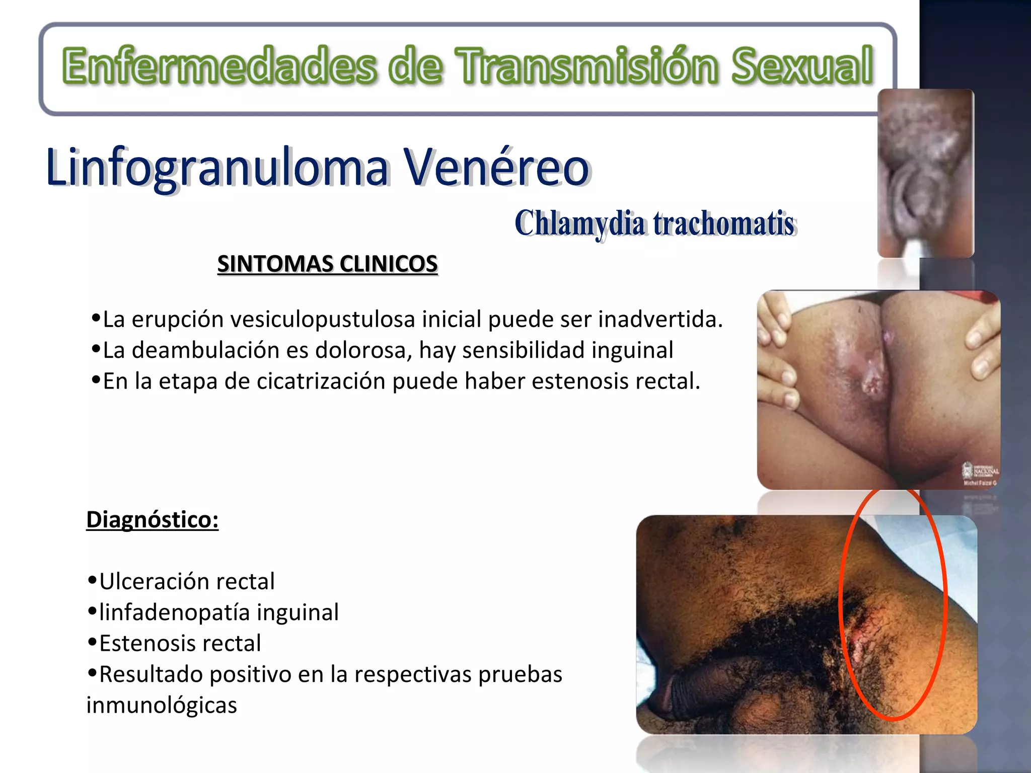 Chlamydia trachomatis La erupción vesiculopustulosa inicial puede ser inadvertida. La deambulación es dolorosa, hay sensibilidad inguinal En la etapa de cicatrización puede haber estenosis rectal. SINTOMAS CLINICOS Linfogranuloma Venéreo Diagnóstico: Ulceración rectal linfadenopatía inguinal  Estenosis rectal Resultado positivo en la respectivas pruebas inmunológicas 