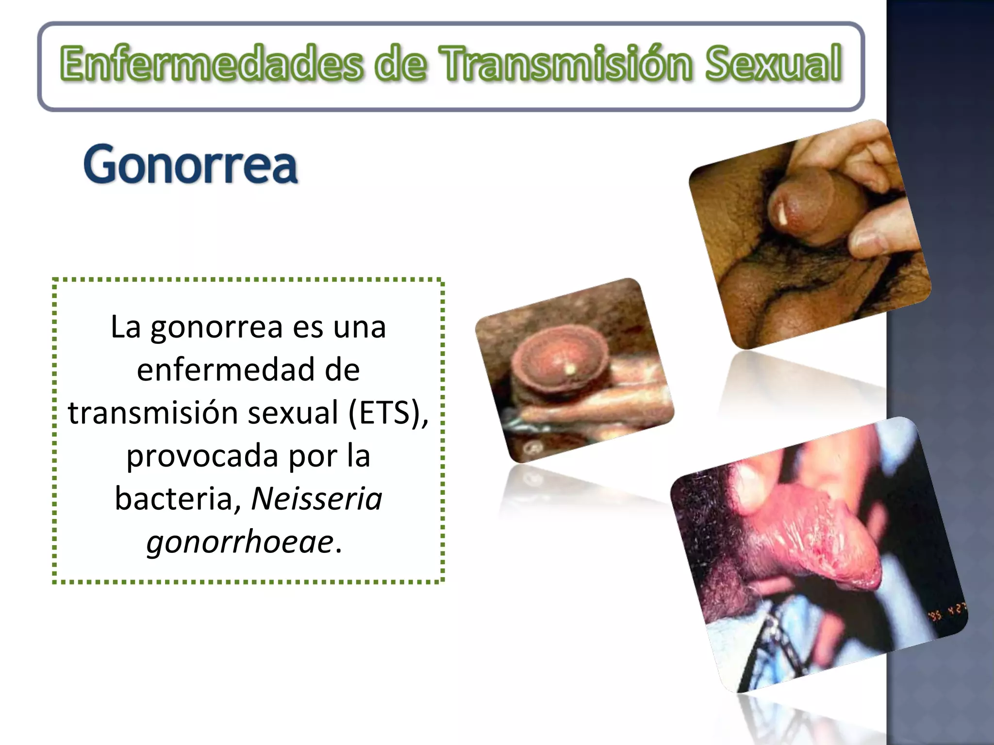 La gonorrea es una enfermedad de transmisión sexual (ETS), provocada por la bacteria,  Neisseria gonorrhoeae .  