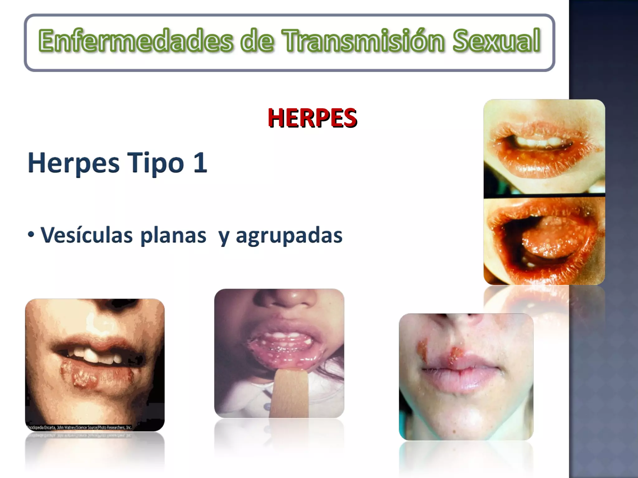 HERPES 