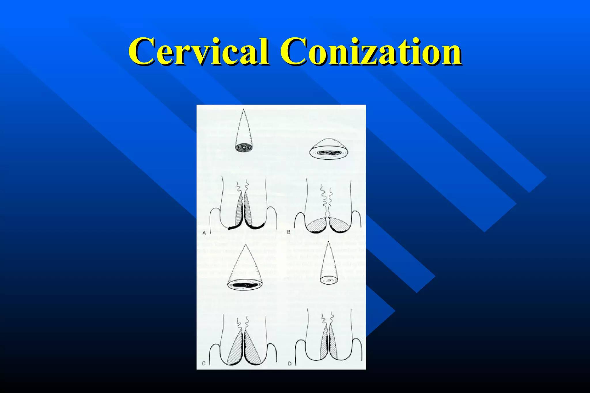 Ckc Conization Servikal Displazi -Pap Smear - Serviks Kanseri - www ...
