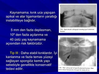 Kaynamama; kırık uca yapışan
apikal ve alar ligamanların yarattığı
instabiliteye bağlıdır.

    5 mm den fazla deplasman,
   10º den fazla açılanma ve
   40 üstü yaş kaynamama
açısından risk faktörüdür.

   Tip III : Daha stabil kırıklardır. İyi
kanlanma ve fazla temas yüzeyi
sağlayan spongiöz kemik yapı
sebebiyle genellikle konservatif
tedavi edilir.
 