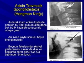 Axisin Travmatik
       Spondilolistezisi
       (Hangman Kırığı)

   Asılarak idam edilen kişilerde
görülen bu kırık günümüzde daha
çok trafik kazaları sonucunda
ortaya çıkar.

  Ani ivme kaybı sonucu başın
öne gitmesidir.

  Boynun fleksiyonda aksiyel
yüklenilmesi sırasında disk ve
bağlarda zarar görür C2, C3
üzerinden öne kayar.
 