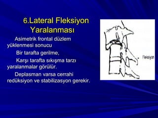 6.Lateral Fleksiyon
         Yaralanması
   Asimetrik frontal düzlem
yüklenmesi sonucu
    Bir tarafta gerilme,
    Karşı tarafta sıkışma tarzı
yaralanmalar görülür.
   Deplasman varsa cerrahi
redüksiyon ve stabilizasyon gerekir.
 