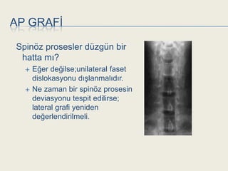 AP GRAFĠ

Spinöz prosesler düzgün bir
 hatta mı?
     Eğer değilse;unilateral faset
      dislokasyonu dıĢlanmalıdır.
     Ne zaman bir spinöz prosesin
      deviasyonu tespit edilirse;
      lateral grafi yeniden
      değerlendirilmeli.
 