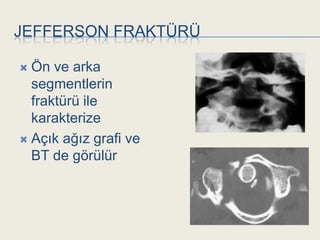 JEFFERSON FRAKTÜRÜ

 Ön ve arka
  segmentlerin
  fraktürü ile
  karakterize
 Açık ağız grafi ve
  BT de görülür
 