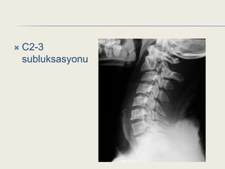    C2-3
    subluksasyonu
 