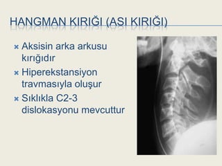 HANGMAN KIRIĞI (ASI KIRIĞI)

 Aksisin arka arkusu
  kırığıdır
 Hiperekstansiyon
  travmasıyla oluĢur
 Sıklıkla C2-3
  dislokasyonu mevcuttur
 