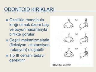 ODONTOĠD KIRIKLARI

 Özellikle mandibula
  kırığı olmak üzere baĢ
  ve boyun hasarlarıyla
  birlikte görülür
 ÇeĢitli mekanizmalarla
  (fleksiyon, ekstansiyon,
   rotasyon) oluĢabilir
 Tip III cerrahi tedavi
  gerektirir
 