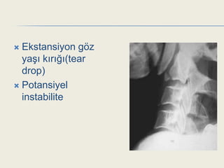  Ekstansiyon göz
  yaĢı kırığı(tear
  drop)
 Potansiyel
  instabilite
 