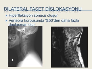 BILATERAL FASET DĠSLOKASYONU
 Hiperfleksiyon sonucu oluĢur
 Vertebra korpusunda %50’den daha fazla
  deplasman olur
 