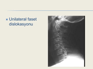    Unilateral faset
    dislokasyonu
 