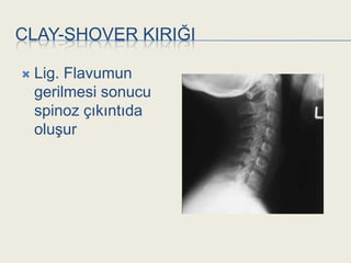 CLAY-SHOVER KIRIĞI

   Lig. Flavumun
    gerilmesi sonucu
    spinoz çıkıntıda
    oluĢur
 