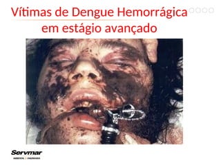 Vítimas de Dengue Hemorrágica
em estágio avançado
 