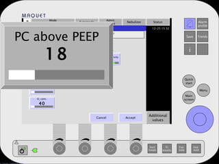 Mode Volume Control Automode Admit patient Nebulizer Status Additional values Set ventilation mode Pressure control   Automode Ti =1.33 s  (33%) PC above PEEP 18 Resp. Rate 15 PEEP 5 O 2  conc. 40 I:E 1:2.0 T. Insp. rise 5 Trigger sensitivity V Basic I:E Trigger . Cancel Accept PC above PEEP 18 