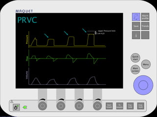 PRVC Pressure Flow Volume Upper Pressure limit 5 cm H 2 O 
