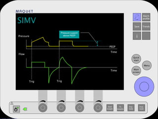 SIMV Pressure Flow PEEP Time Pressure support above PEEP Trig Trig Time 