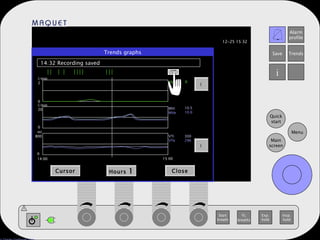 Trends graphs 14:32 Recording saved Cursor Hours  1 Close   14:00 15:00 l/min 2 l/min 20 ml 800 0 0 0 Vee MVi MVe VTi VTe 0 10.5 10.0 300 296 