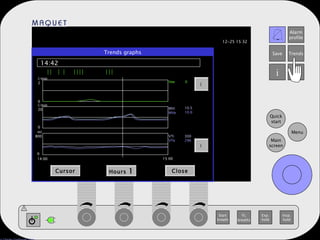Trends graphs 14:42 Cursor Hours  1 Close   14:00 15:00 l/min 2 l/min 20 ml 800 0 0 0 Vee MVi MVe VTi VTe 0 10.5 10.0 300 296 