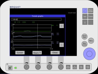Trends graphs 14:42 Cursor Hours  1 Close   14:00 15:00 l/min 2 l/min 20 ml 800 0 0 0 Vee MVi MVe VTi VTe 0 10.5 10.0 300 296 