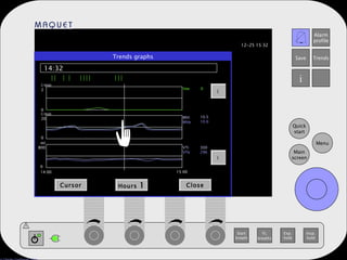 Trends graphs 14:32 Cursor Hours  1 Close   14:00 15:00 l/min 2 l/min 20 ml 800 0 0 0 Vee MVi MVe VTi VTe 0 10.5 10.0 300 296 
