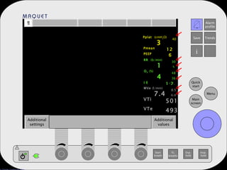 Additional settings Additional values Pmean 12 PEEP 6 RR  (b/min) 15 30 5 O 2   (%) 42 48 36 I:E 1:2.0 MVe  (l/min) 7.4 8.5 6.0 VTi 501 VTe 493 Pplat  (cmH 2 O) 34 40 