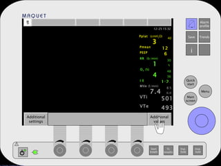 Additional settings Additional values Pmean 12 PEEP 6 RR  (b/min) 15 30 5 O 2   (%) 42 48 36 I:E 1:2.0 MVe  (l/min) 7.4 8.5 6.0 VTi 501 VTe 493 Pplat  (cmH 2 O) 34 40 