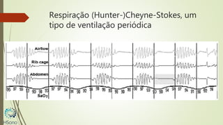 Respiração (Hunter-)Cheyne-Stokes, um
tipo de ventilação periódica
 