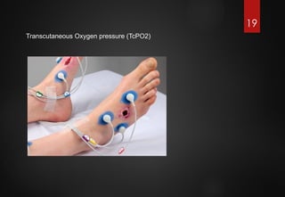 Komplikasi Diabetes pada Arteri Perifer: Diagnosis dan Penatalaksanaan ...