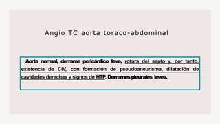 Aorta normal, derrame pericárdico leve, rotura del septo y, por tanto,
existencia de CIV, con formación de pseudoaneurisma, dilatación de
cavidades derechas y signos de HTP. Derramespleurales leves.
Angio TC aorta toraco-abdominal
 