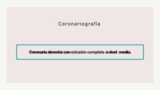 Coronariaderechaconoclusión completa anivel medio.
Coronariografía
 