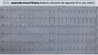 ECG: taquicardiasinusal(150lpm),Ondas Q y elevación del segmento ST en cara inferior
 