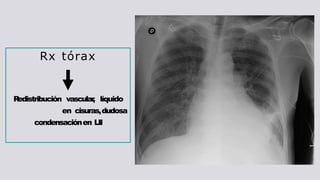 Rx tórax
R
edistribución vascular
, líquido
en cisuras,dudosa
condensaciónen LII
 