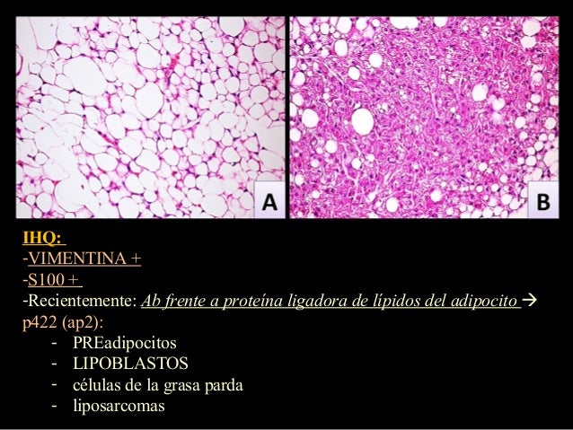 Angiolipoma | Radiology Reference Article | Radiopaedia.org