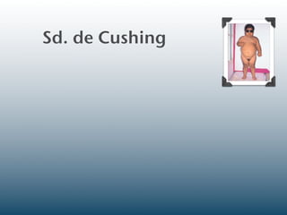 Sd. de Cushing
 