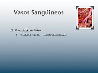 Vasos Sangúineos

Ecografía carotídea:
   Hipertrofia vascular - Aterosclerosis subclínica
 
