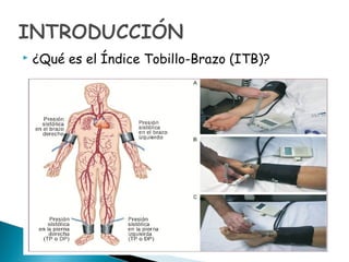  ¿Qué es el Índice Tobillo-Brazo (ITB)?
 
