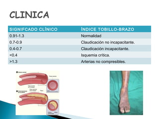 SIGNIFCADO CLÍNICO ÍNDICE TOBILLO-BRAZO
0.91-1.3 Normalidad
0.7-0.9 Claudicación no incapacitante.
0.4-0.7 Claudicación incapacitante.
<0.4 Isquemia crítica.
>1.3 Arterias no compresibles.
 