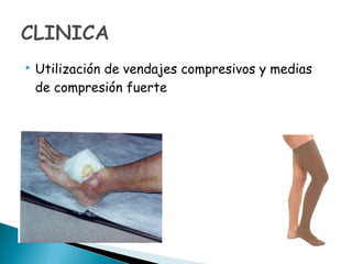  Utilización de vendajes compresivos y medias
de compresión fuerte
 