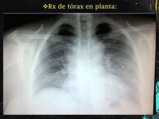 Rx de tórax en planta:
 