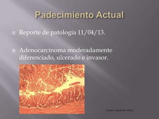  Reporte de patología 11/04/13.
 Adenocarcinoma moderadamente
diferenciado, ulcerado e invasor.
Fuente: expediente clínico
 