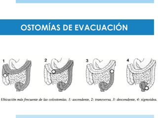 OSTOMÍAS DE EVACUACIÓN
 