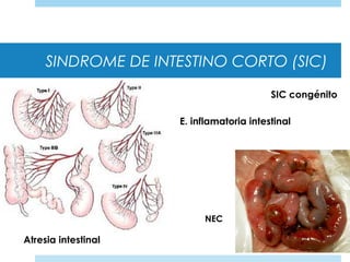 SINDROME DE INTESTINO CORTO (SIC)
Atresia intestinal
SIC congénito
E. inflamatoria intestinal
NEC
 