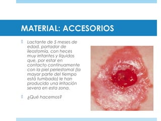 MATERIAL: ACCESORIOS
 Lactante de 5 meses de
edad, portador de
ileostomía, con heces
muy irritantes y líquidas
que, por estar en
contacto continuamente
con la piel periestomal (la
mayor parte del tiempo
está tumbado) le han
producido una irritación
severa en esta zona.
 ¿Qué hacemos?
 